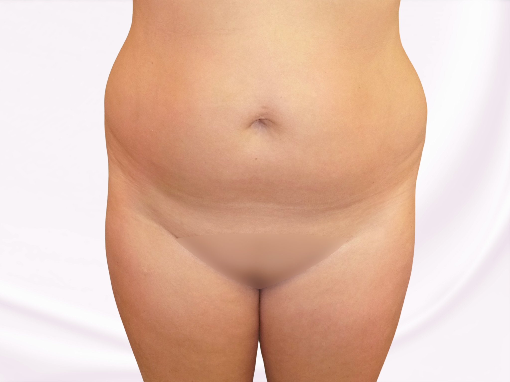liposukce boků před zákrokem liposukce boků před zákrokem