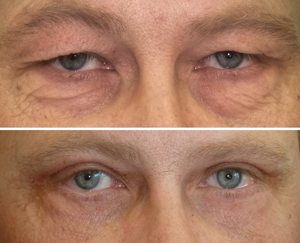 Operace očních víček Plasticare před a po