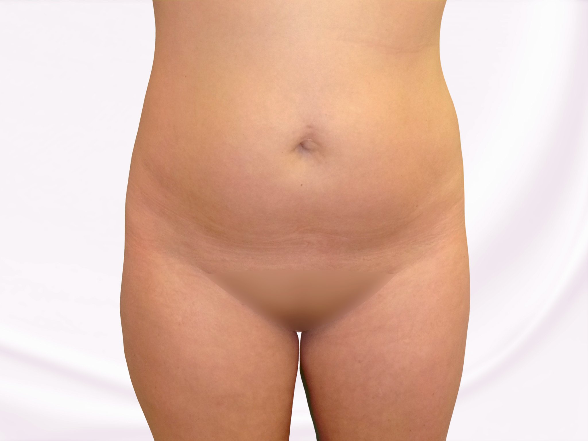 liposukce boků po zákroku liposukce boků po zákroku