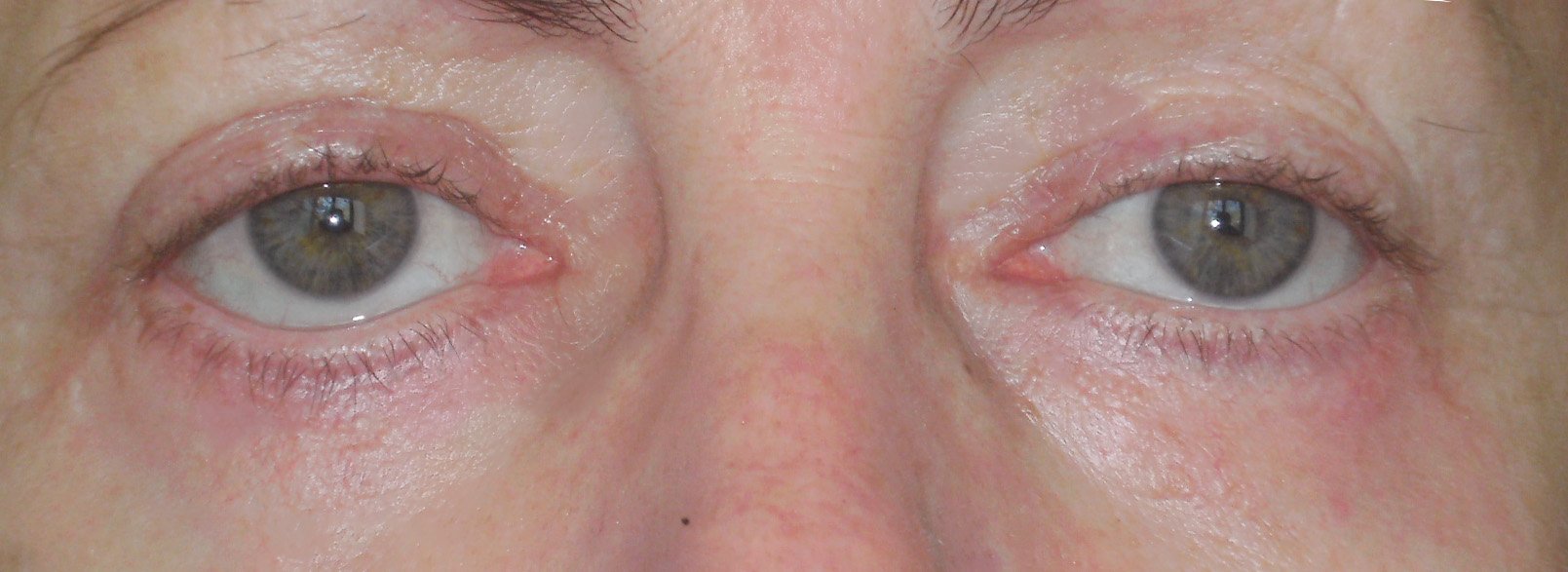 dolní víčka - po Ukázka očních víček po zákroku