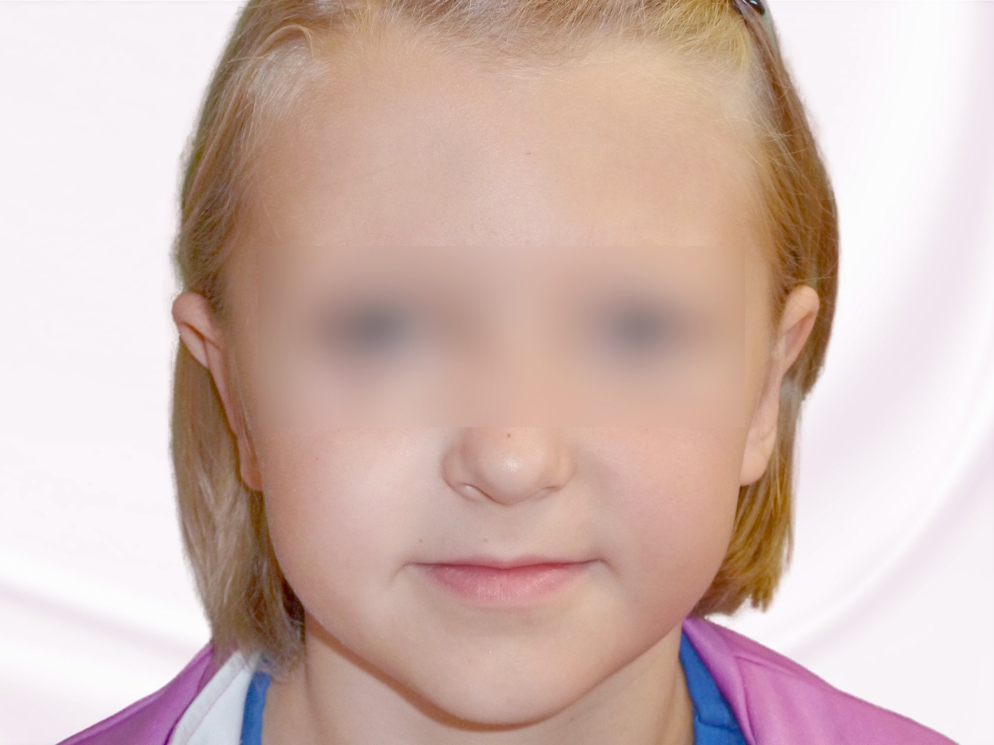 Plastika uší - po zákroku Ukázka výsledku otoplastiky u dítěte