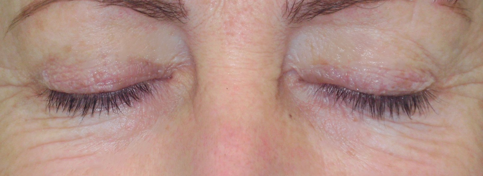 dolní víčka - před Ukázka očních víček před zákrokem