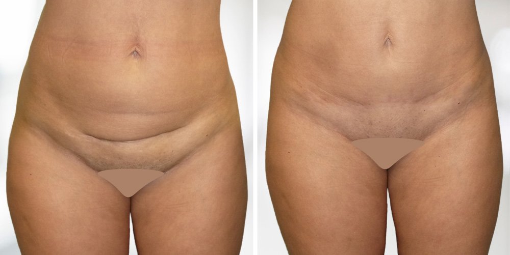 Abdominoplastika neboli plastická operace břicha Plasticare - odstranění přebytečné kůže na břiše před a po