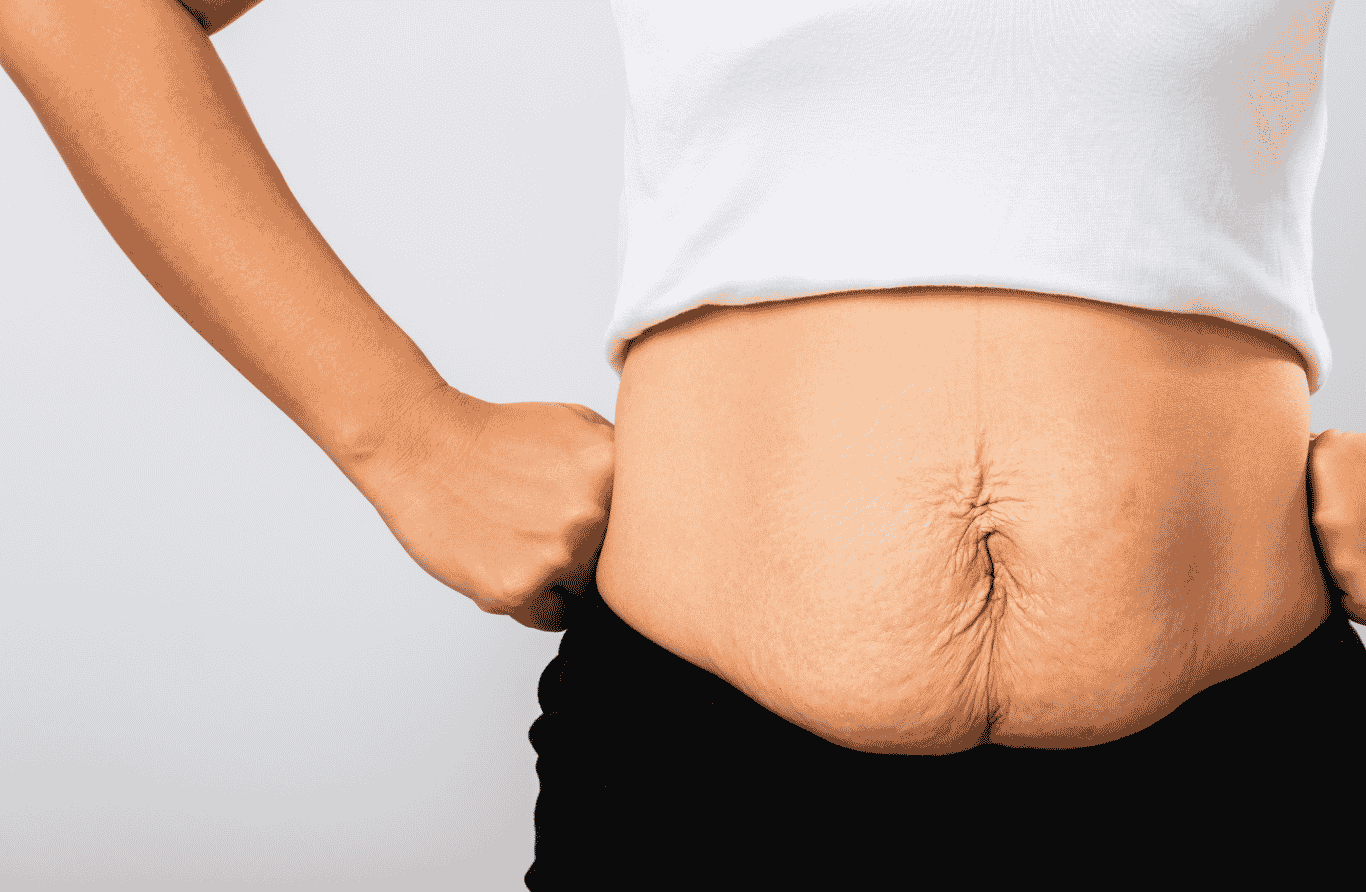 Plastika břicha po porodu nebo zhubnutí: Kdy dává zákrok smysl?